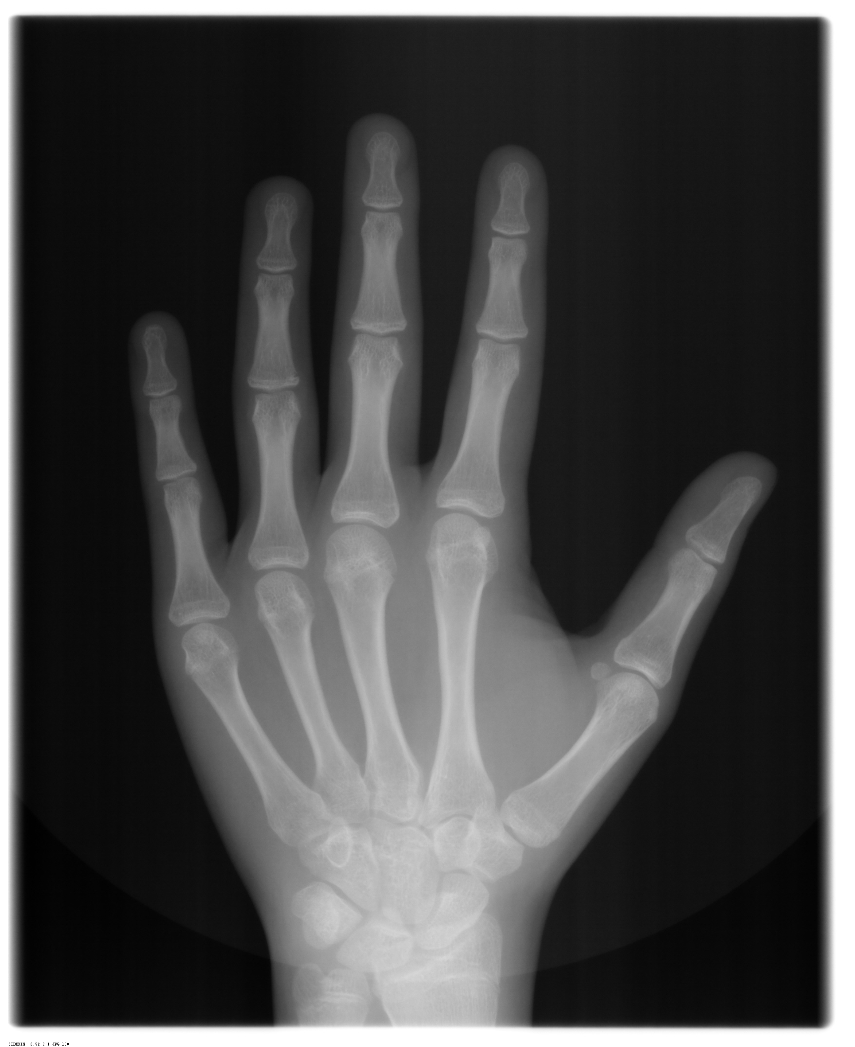 Carpal